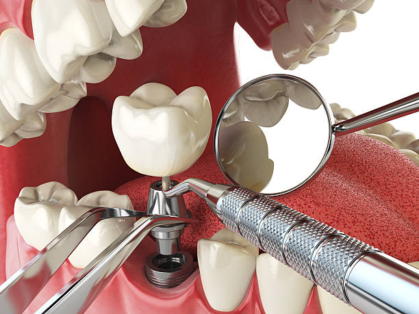 Best Emergency Dentist for Lost Fillings or Crowns in Elleale, ND